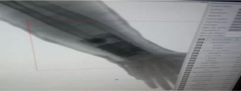 Ao realizar um exame de raio-x foi constatado que um aparelho celular estava dentro do gesso