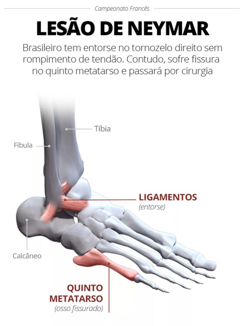 INFO Lesão Neymar